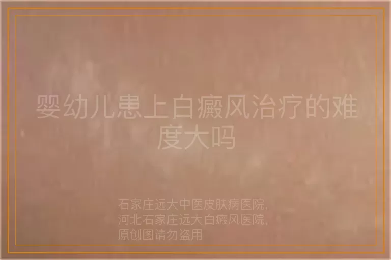 婴幼儿患上白癜风治疗的难度大吗