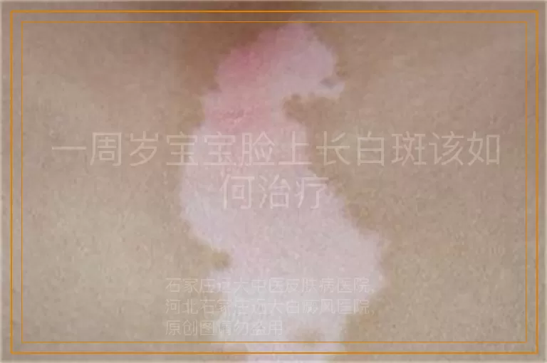 一周岁宝宝脸上长白斑该如何治疗