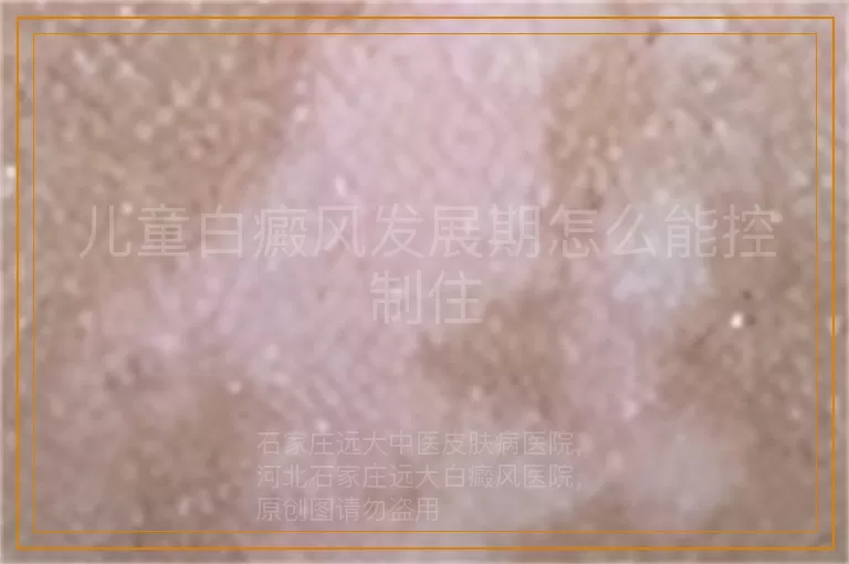 儿童白癜风发展期怎么能控制住