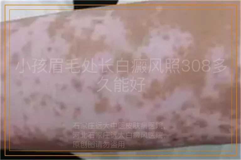 小孩眉毛处长白癜风照308多久能好