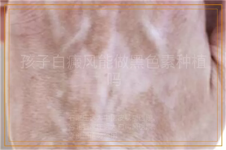 孩子白癜风能做黑色素种植吗