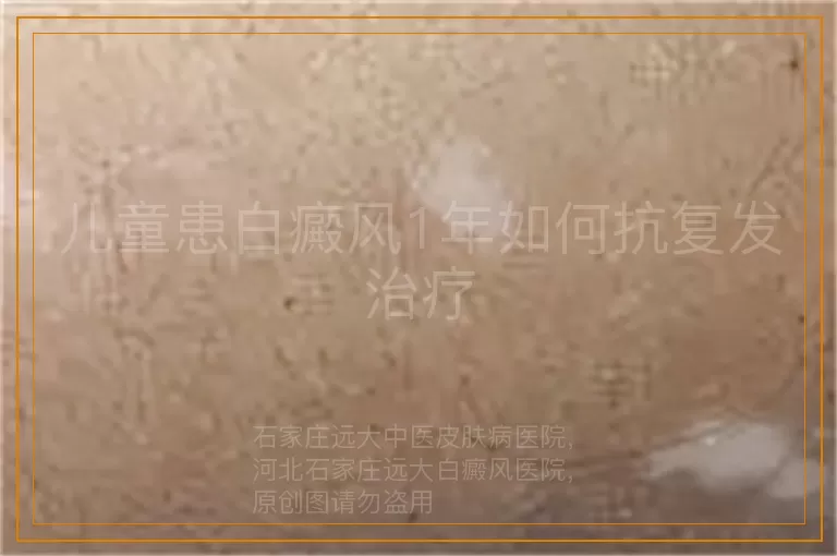 儿童患白癜风1年如何抗复发治疗