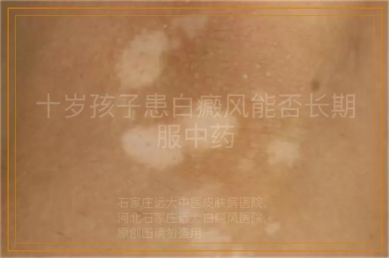 十岁孩子患白癜风能否长期服中药