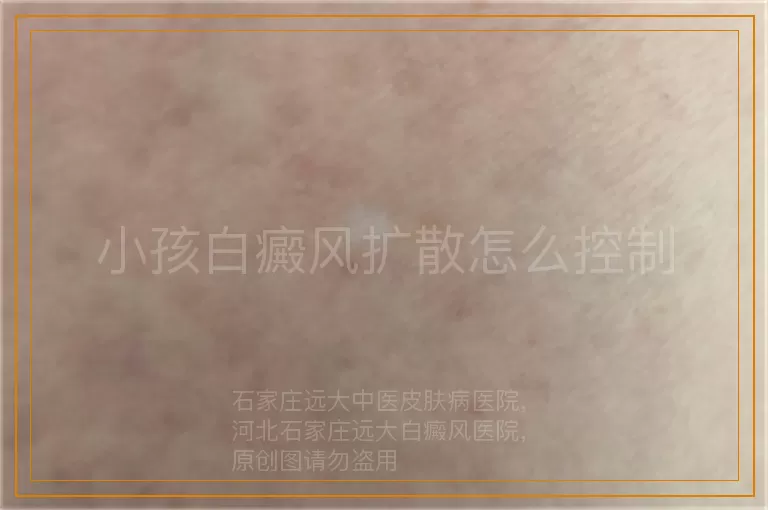 小孩白癜风扩散怎么控制
