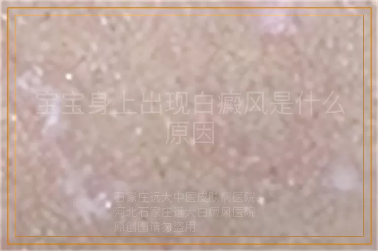 宝宝身上出现白癜风是什么原因