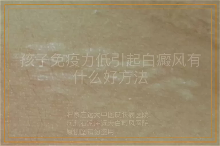 孩子免疫力低引起白癜风有什么好方法