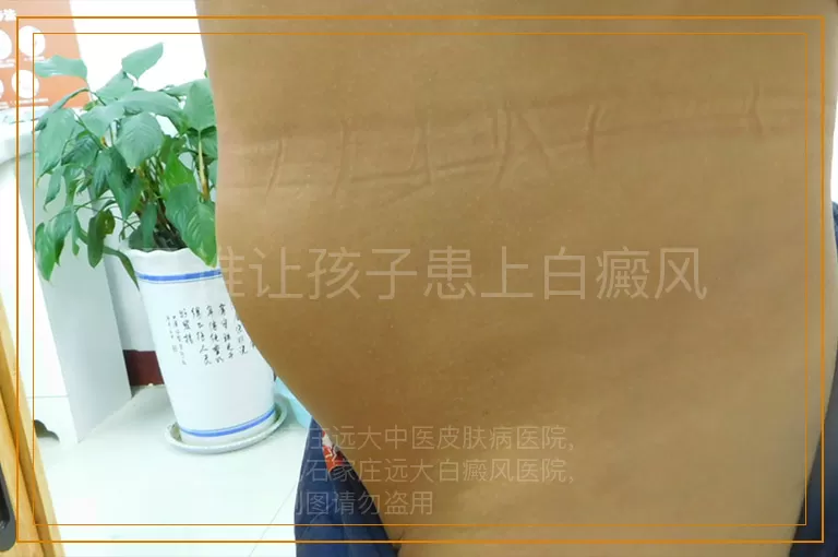 是谁让孩子患上白癜风