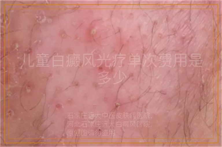 儿童白癜风光疗单次费用是多少