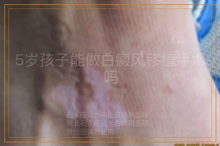 5岁孩子能做白癜风移植手术吗
