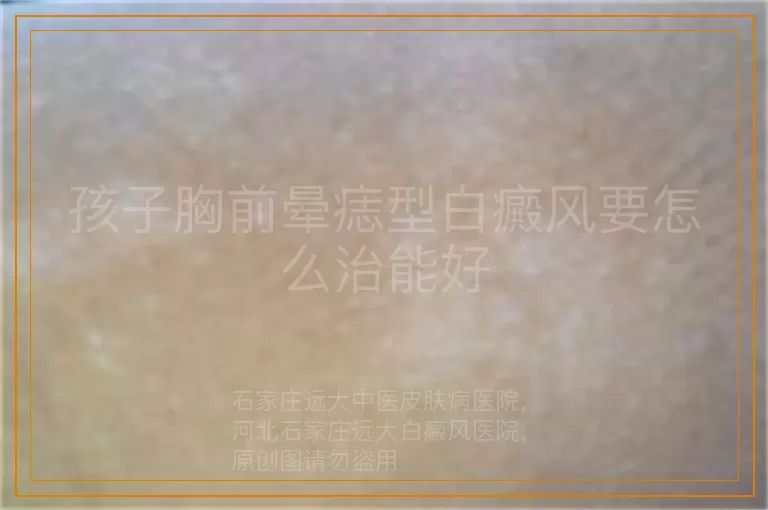 孩子胸前晕痣型白癜风要怎么治能好