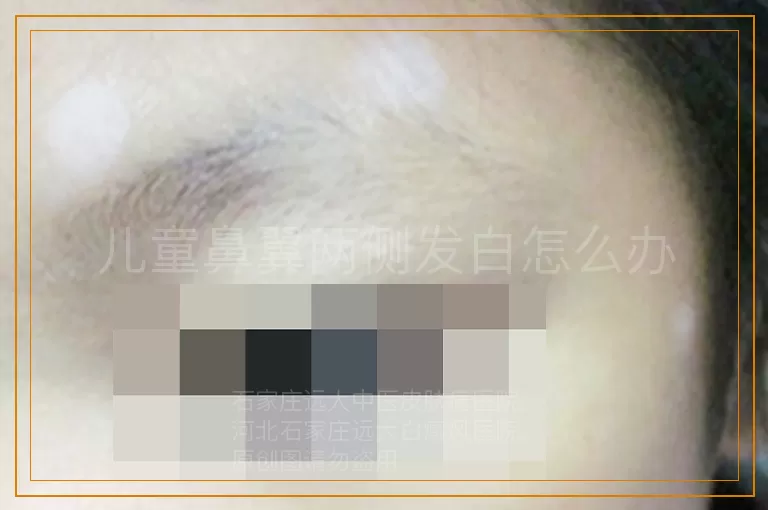 儿童鼻翼两侧发白怎么办