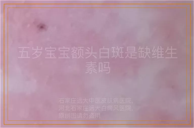 五岁宝宝额头白斑是缺维生素吗