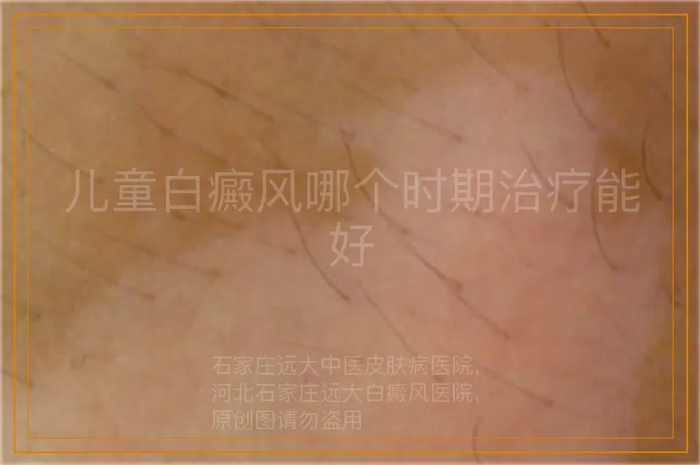 儿童白癜风哪个时期治疗能好