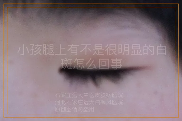 小孩腿上有不是很明显的白斑怎么回事