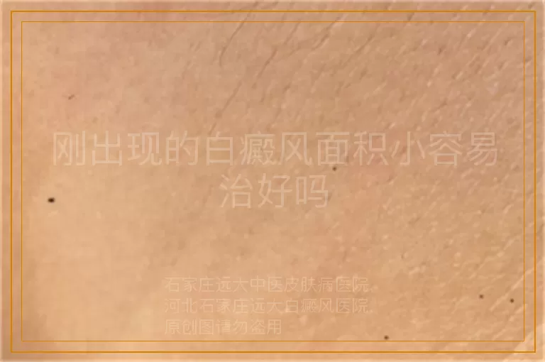 刚出现的白癜风面积小容易治好吗