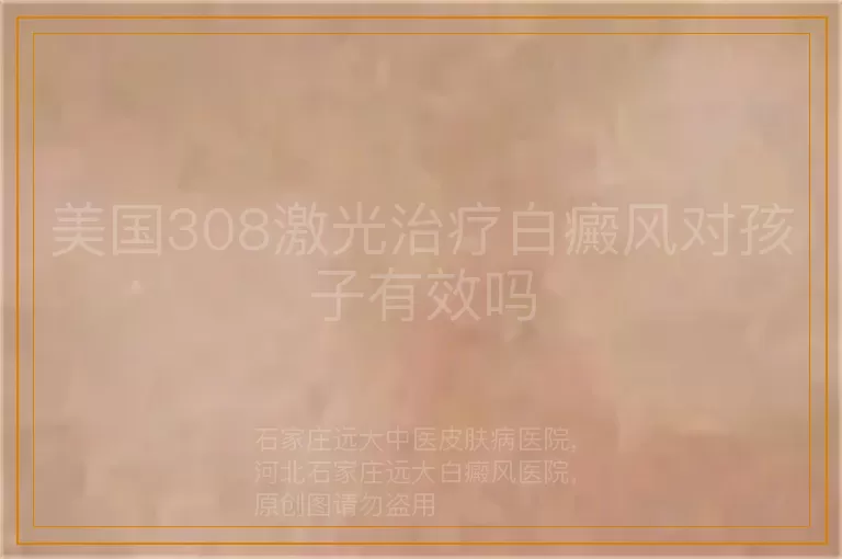 美国308激光治疗白癜风对孩子有效吗