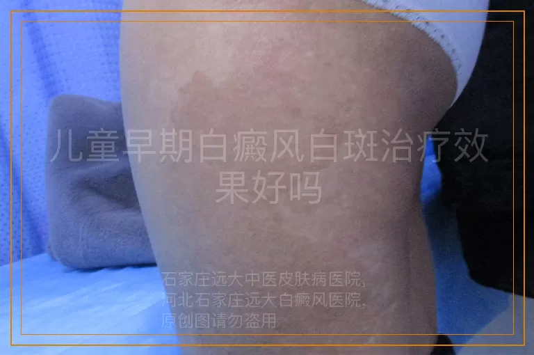 儿童早期白癜风白斑治疗效果好吗