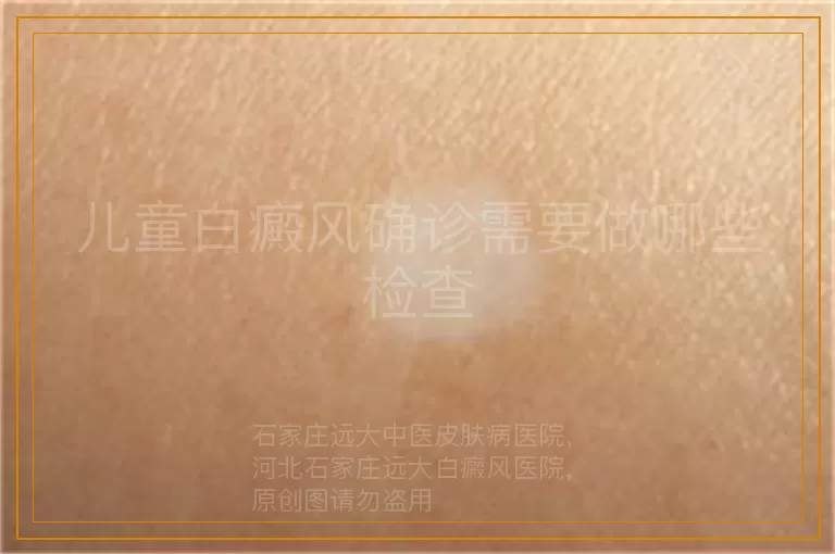 儿童白癜风确诊需要做哪些检查