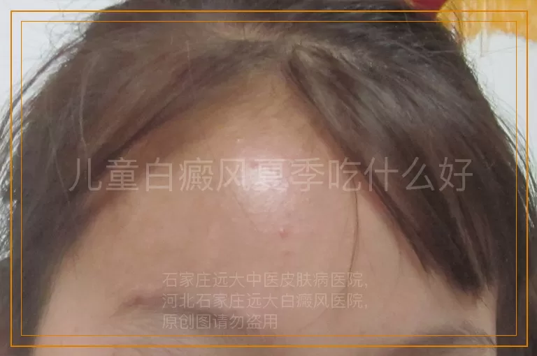 儿童白癜风夏季吃什么好