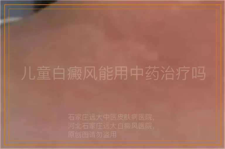 儿童白癜风能用中药治疗吗