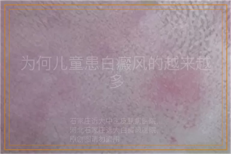 为何儿童患白癜风的越来越多