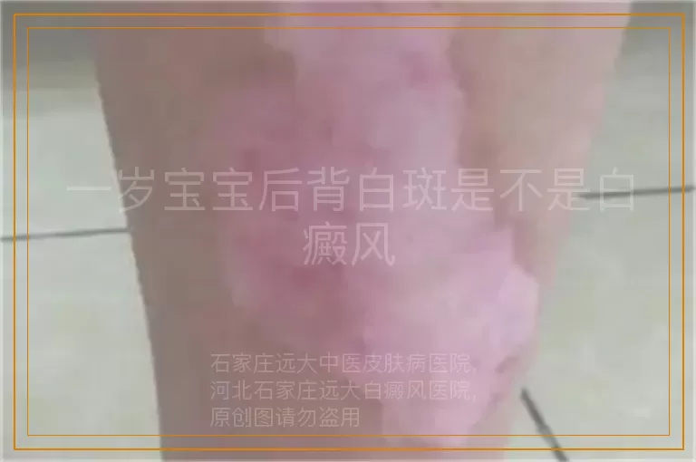一岁宝宝后背白斑是不是白癜风