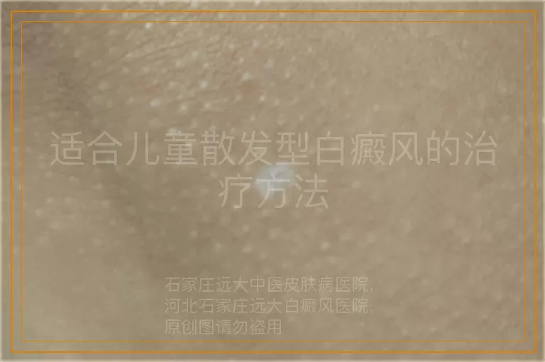 适合儿童散发型白癜风的治疗方法