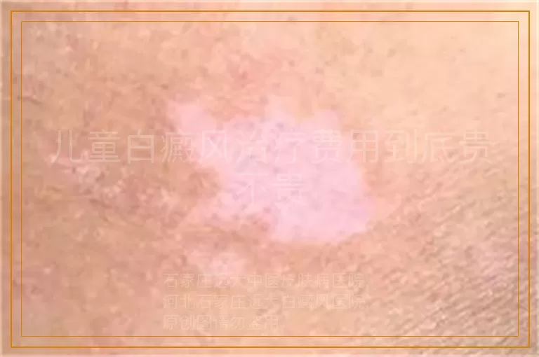 儿童白癜风治疗费用到底贵不贵