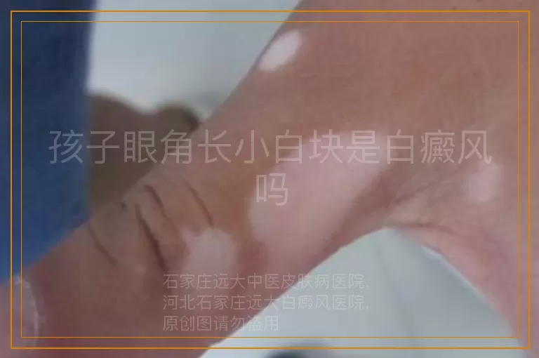 孩子眼角长小白块是白癜风吗