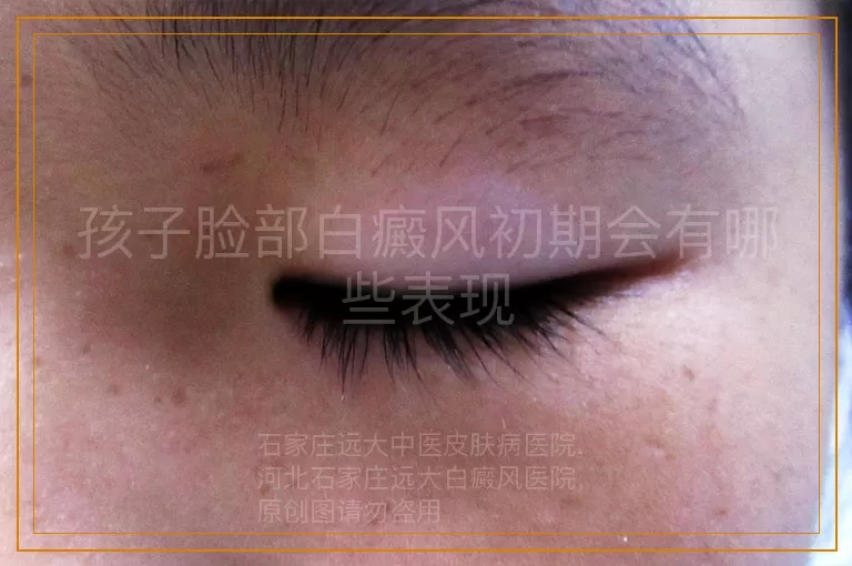 孩子脸部白癜风初期会有哪些表现
