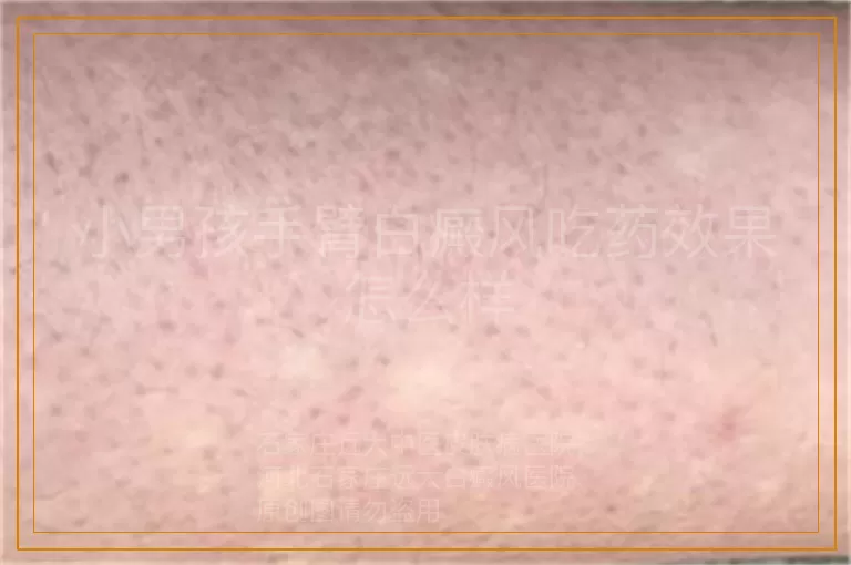 小男孩手臂白癜风吃药效果怎么样