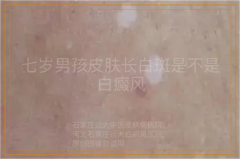 七岁男孩皮肤长白斑是不是白癜风
