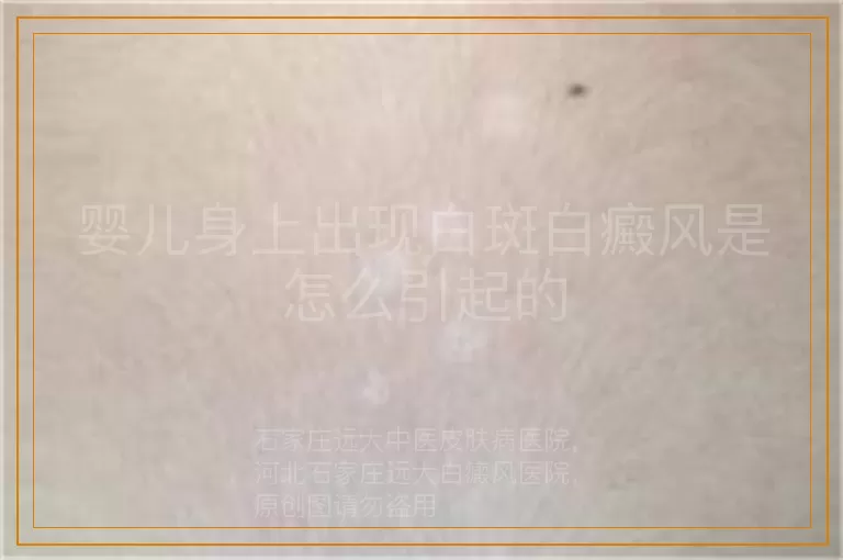 婴儿身上出现白斑白癜风是怎么引起的