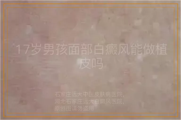 17岁男孩面部白癜风能做植皮吗