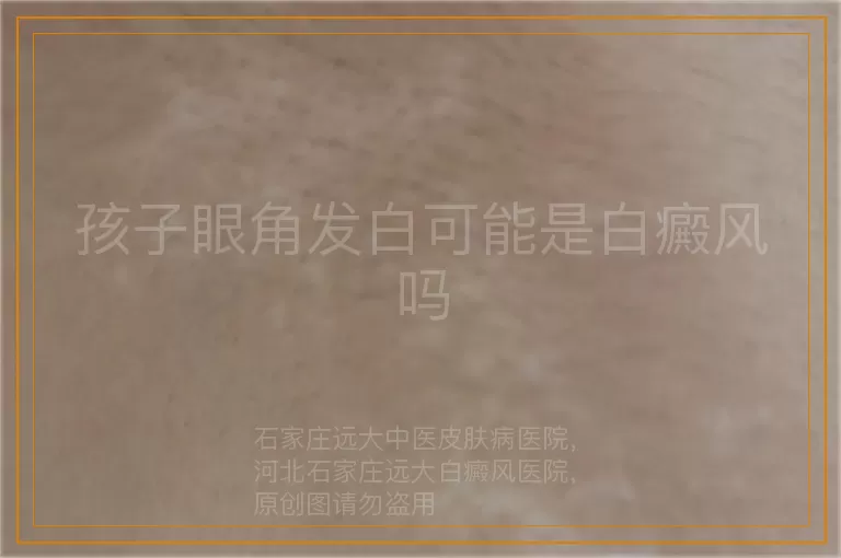 孩子眼角发白可能是白癜风吗