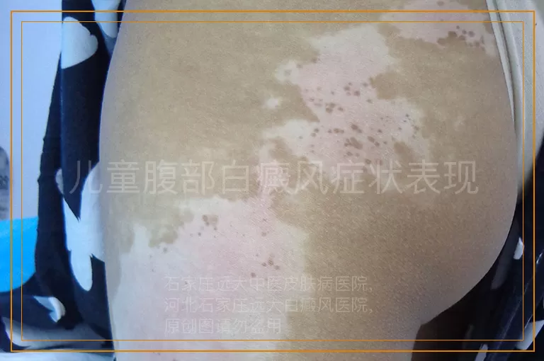 儿童腹部白癜风症状表现