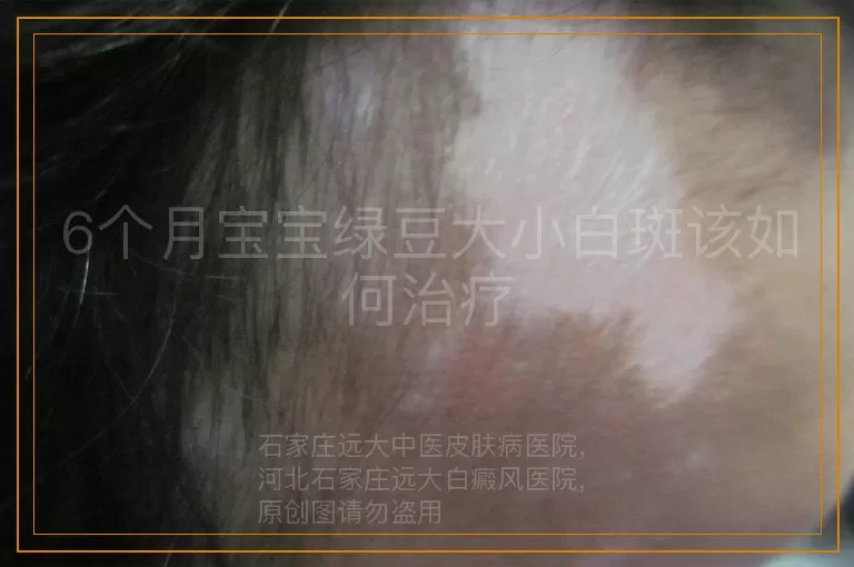 6个月宝宝绿豆大小白斑该如何治疗