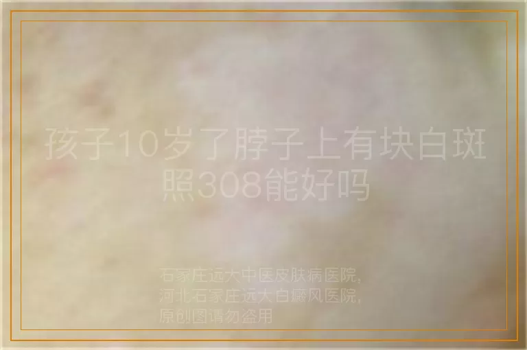 孩子10岁了脖子上有块白斑照308能好吗