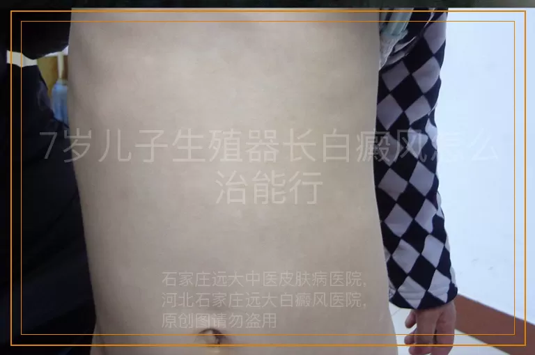 7岁儿子生殖器长白癜风怎么治能行