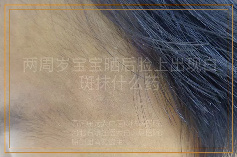 两周岁宝宝晒后脸上出现白斑抹什么药