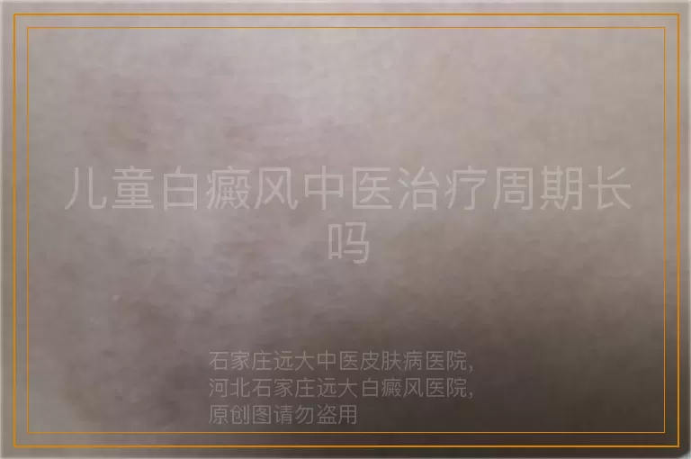 儿童白癜风中医治疗周期长吗