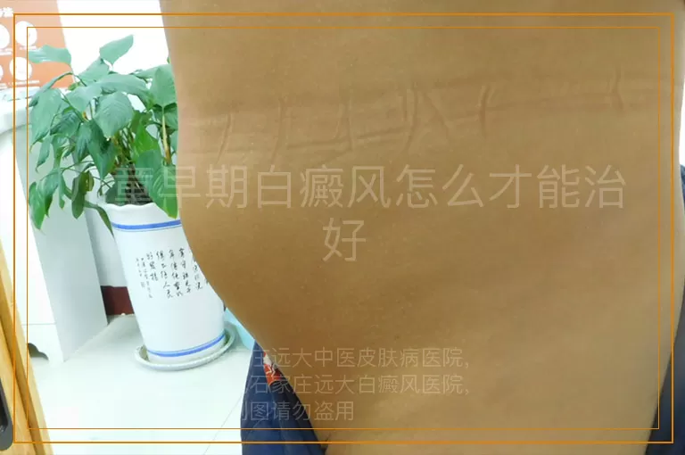 儿童早期白癜风怎么才能治好