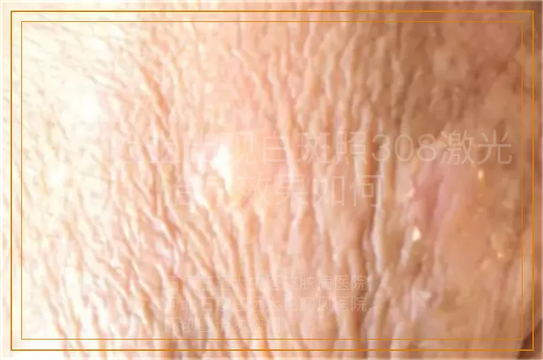 孩子脸上出现白斑照308激光治疗效果如何