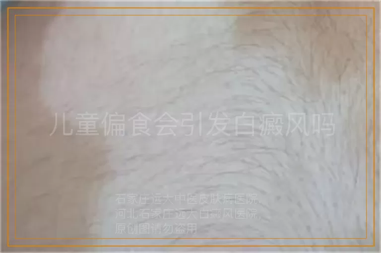 儿童偏食会引发白癜风吗