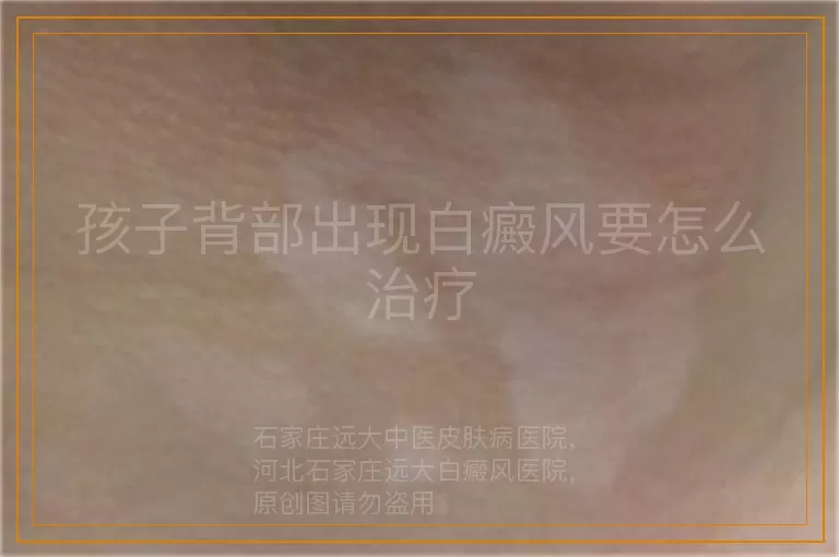孩子背部出现白癜风要怎么治疗