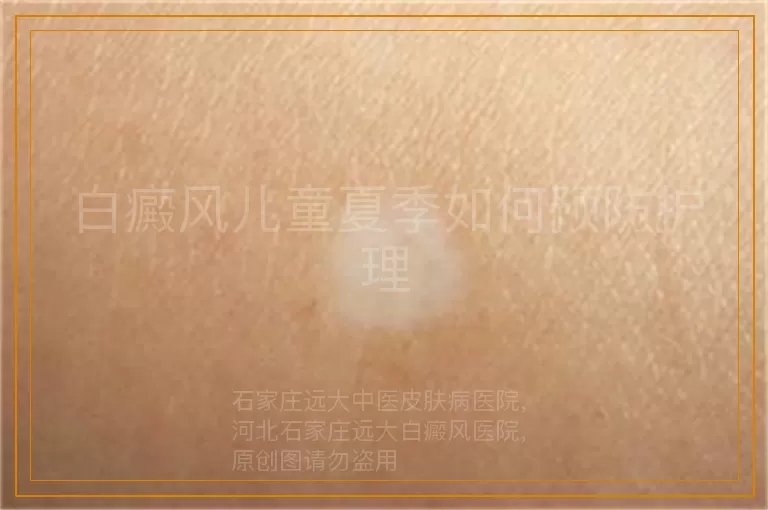 白癜风儿童夏季如何预防护理