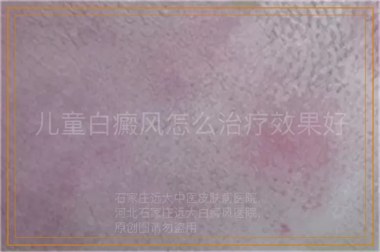 儿童白癜风怎么治疗效果好