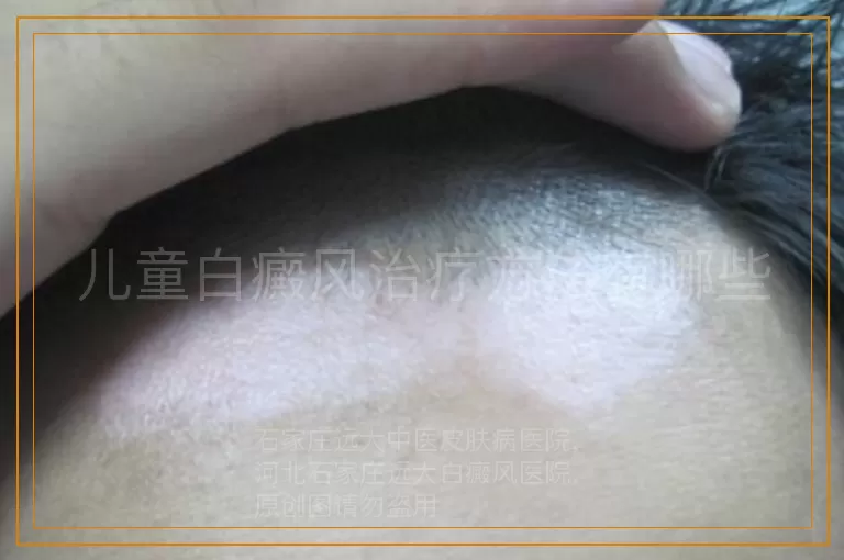 儿童白癜风治疗方法有哪些