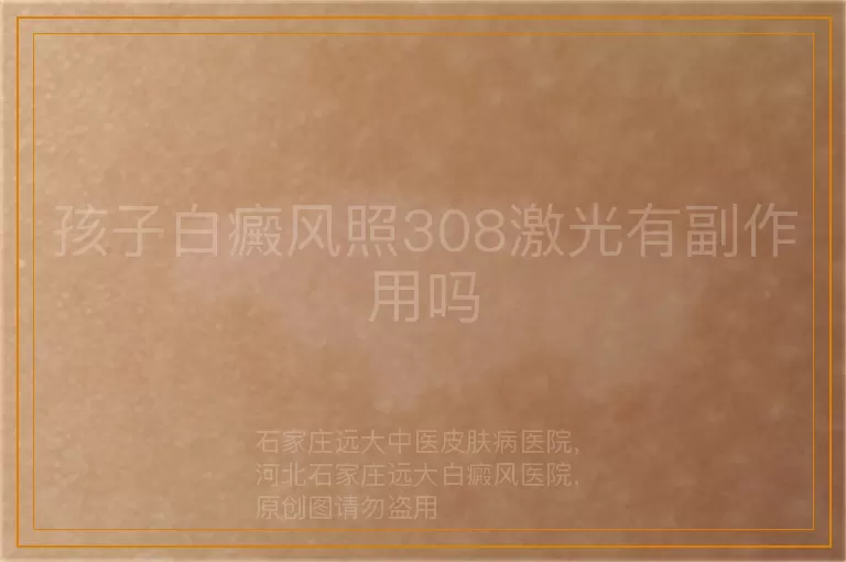 孩子白癜风照308激光有副作用吗