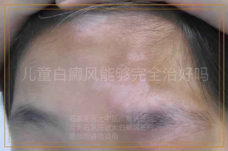 儿童白癜风能够完全治好吗